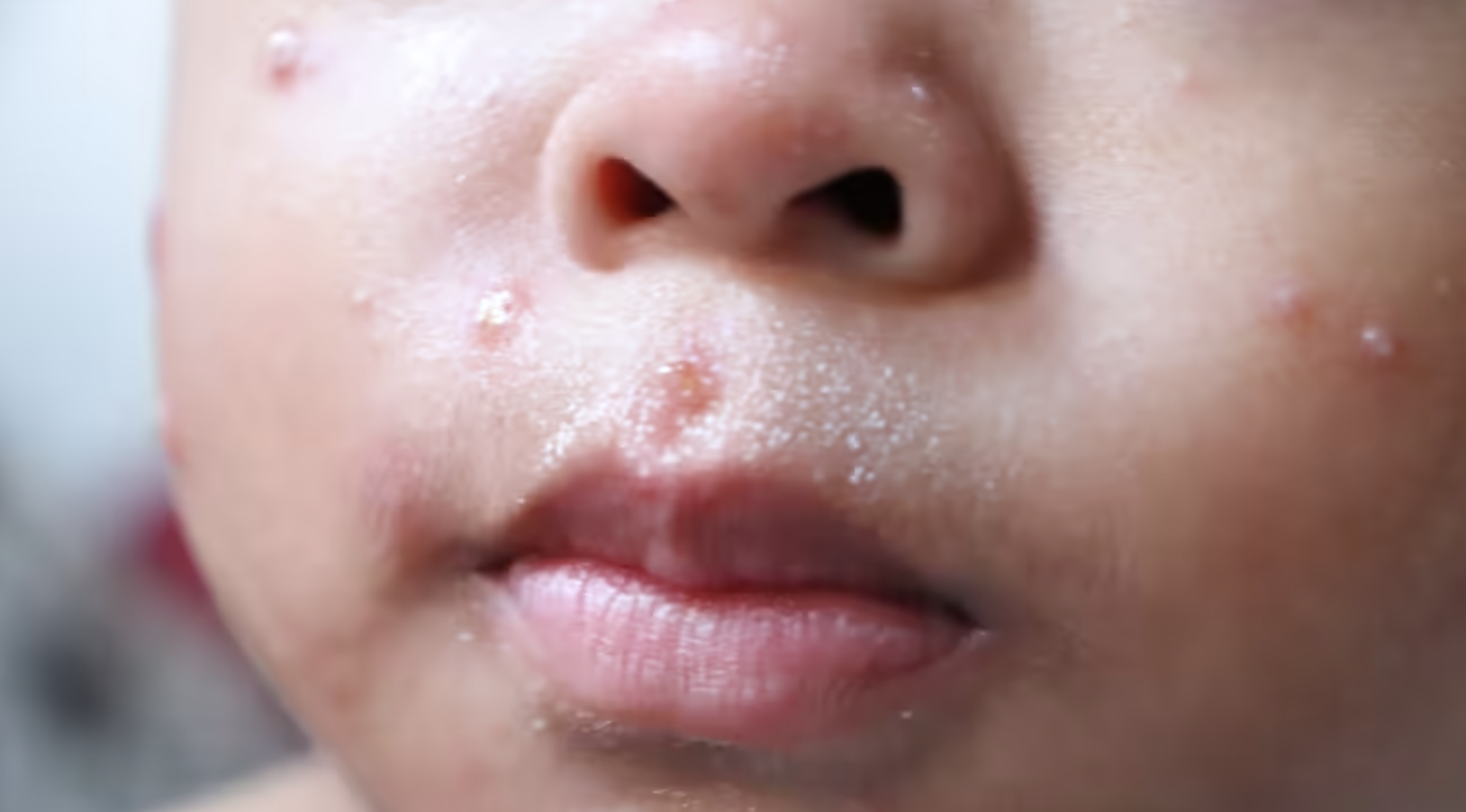 宾州已成为全美麻疹疫情最严重的地区之一!一周猛增近100例!近800人感染!儿童医院、国际机场先后发现暴露风险