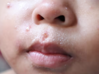 宾州已成为全美麻疹疫情最严重的地区之一!一周猛增近100例!近800人感染!儿童医院、国际机场先后发现暴露风险