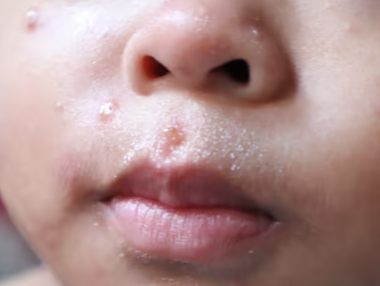 宾州已成为全美麻疹疫情最严重的地区之一!一周猛增近100例!近800人感染!儿童医院、国际机场先后发现暴露风险