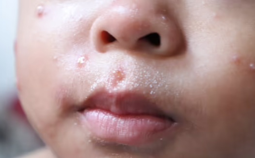 宾州已成为全美麻疹疫情最严重的地区之一！一周猛增近100例！近800人感染！儿童医院、国际机场先后发现暴露风险